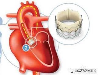 【放射科检查指南】体内装了心脏起搏器、支架