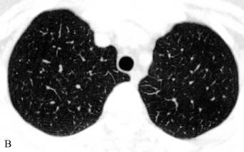 [深度学习] 肺水肿的发生机制及影像诊断(建议