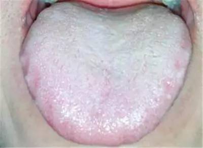 口腔科医生教你:看舌头,知疾病