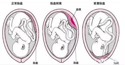 怀孕7次,流产3次,剖宫产4次换血2万毫升生下男