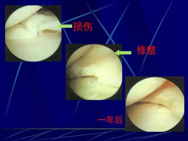 【健康】膝关节常见病之半月板损伤