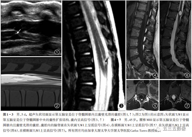 重新正确认识第五脑室的概念及其影像表现