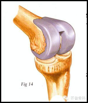 退行性膝关节炎的围手术期宣传手册