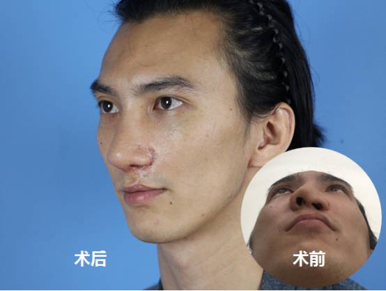 唇裂鼻畸形修复难关被攻克 中国整形外科发展