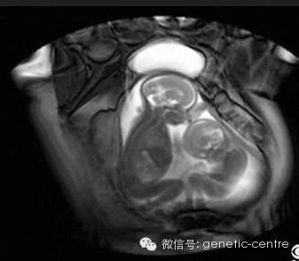 胎儿医学的产前筛查之胎儿磁共振_水滴健康_